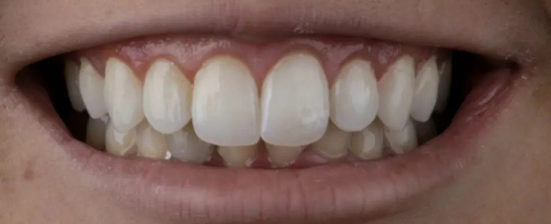 Caso 7: sorriso depois (Resina + gengivoplastia)