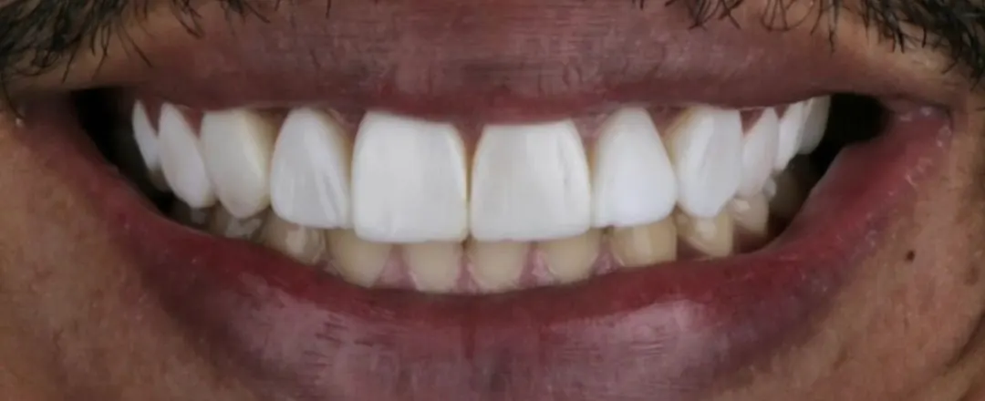 Caso 2: o mesmo sorriso antes