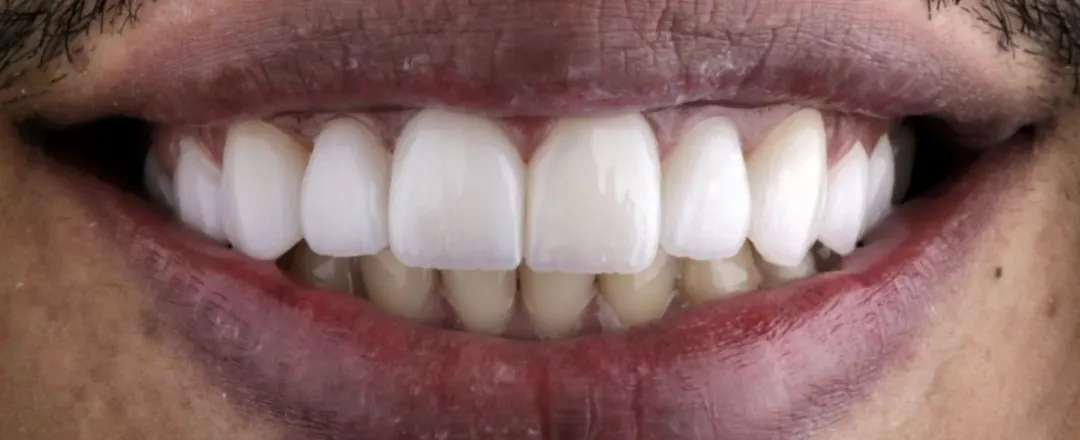 Caso 2: sorriso depois (Laminados cerâmicos)