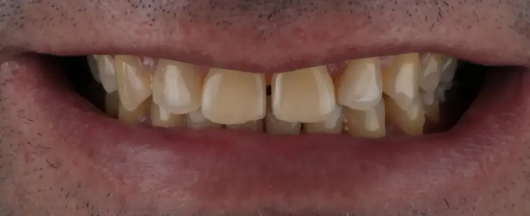 O mesmo sorriso antes do tratamento