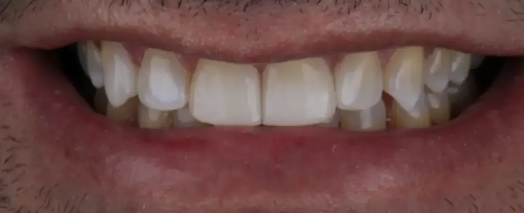 Sorriso depois do tratamento