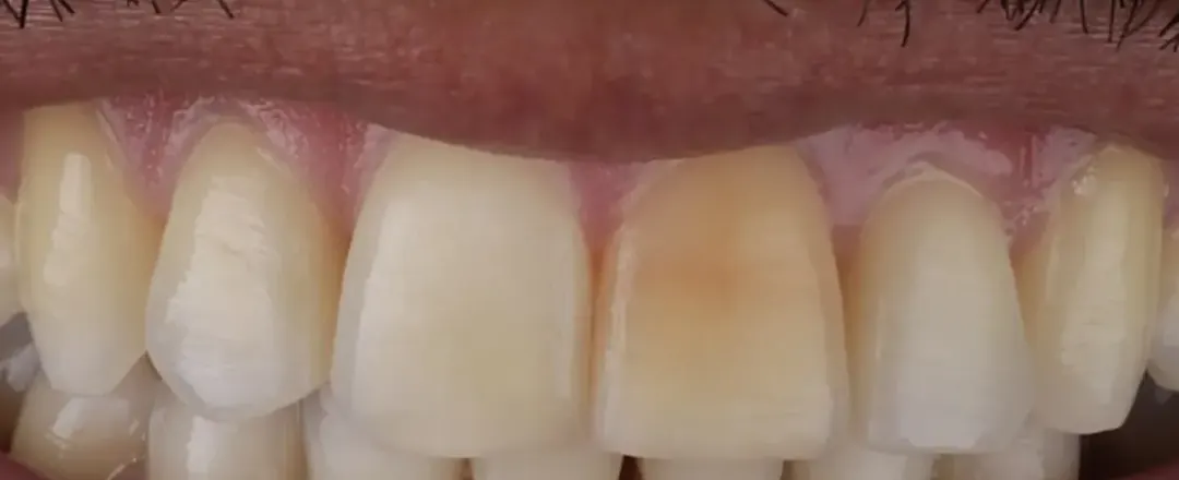Caso 5: o mesmo sorriso antes