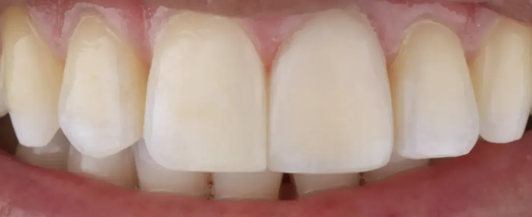 Caso 5: sorriso depois (Dente escurecido)