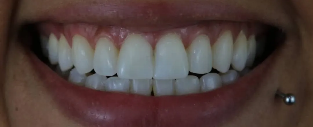 Caso 1: o mesmo sorriso antes