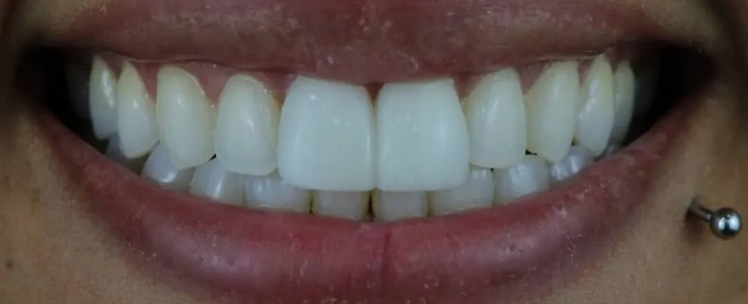Caso 1: sorriso depois (Restaurações)