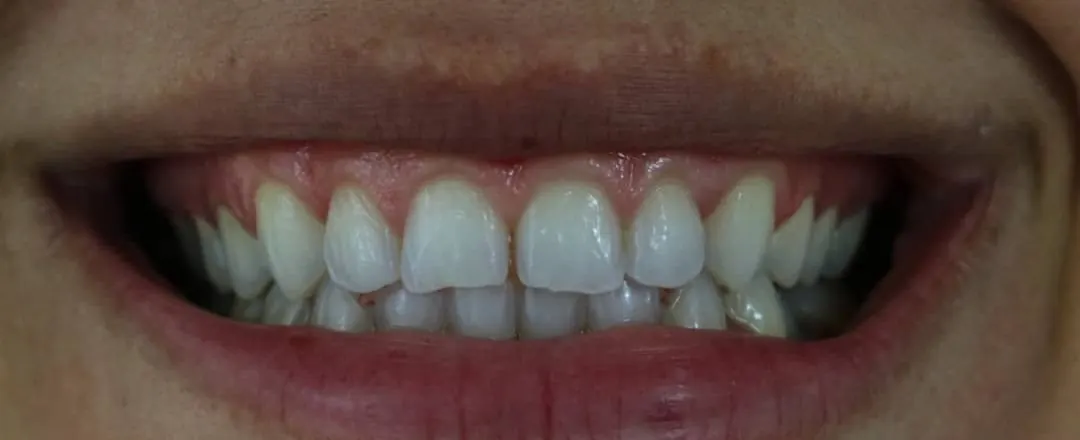 Caso 4: o mesmo sorriso antes
