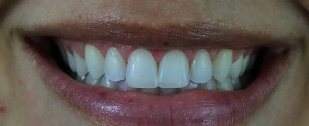 Caso 4: sorriso depois (Diastema)