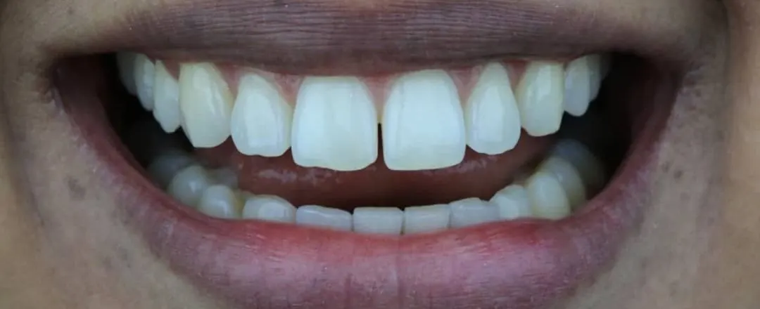 Caso 6: o mesmo sorriso antes
