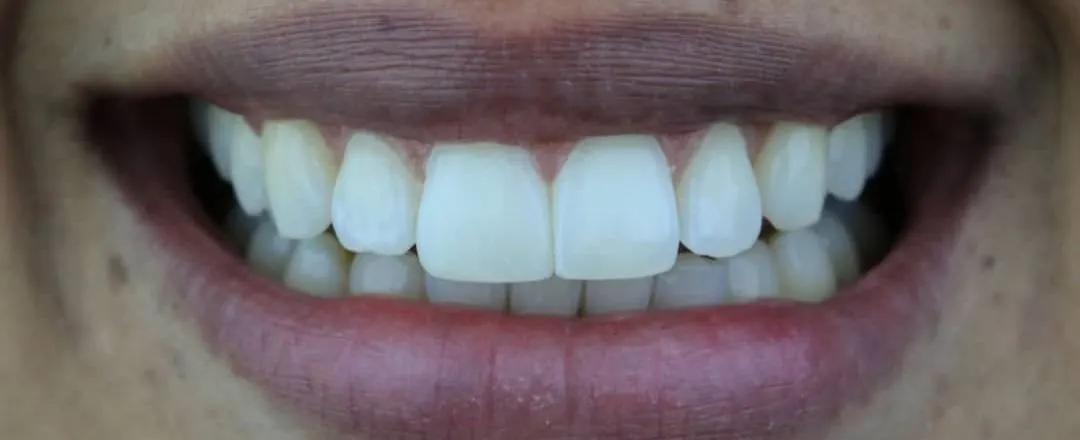Caso 6: sorriso depois (Pós-ortodontia)