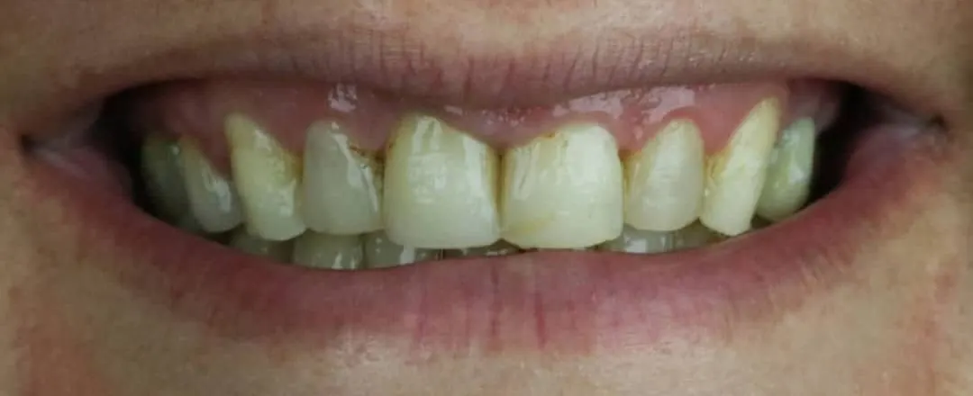 Caso 3: o mesmo sorriso antes