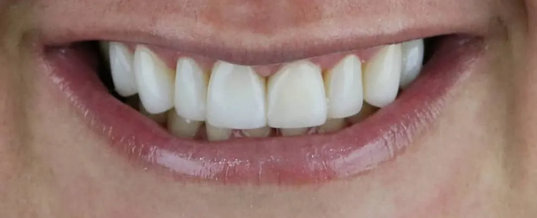 Caso 3: sorriso depois (Gengivoplastia + resina)